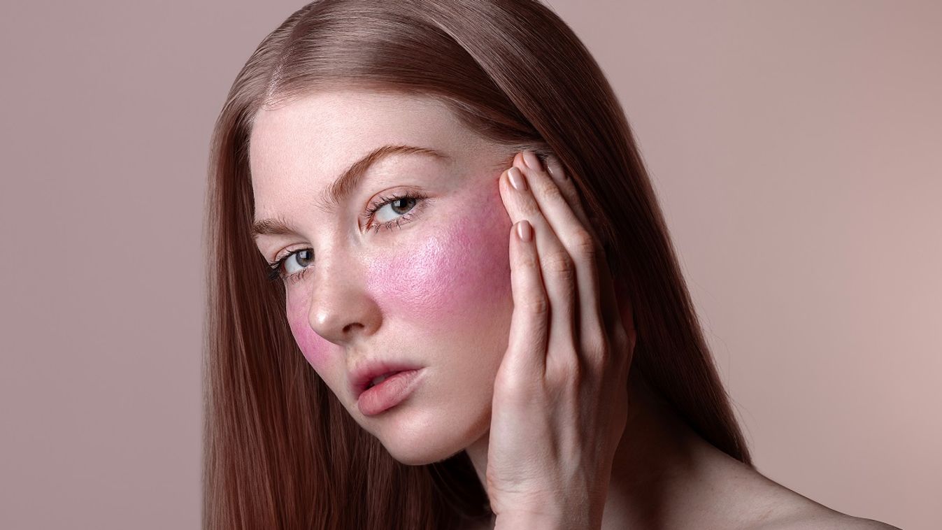 A rosacea az arcbőr egyik leggyakoribb betegsége