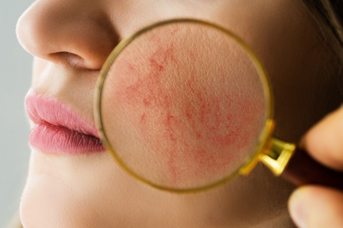 A rosacea egyik tünete, hogy az arcbőrön kitágulnak az erek