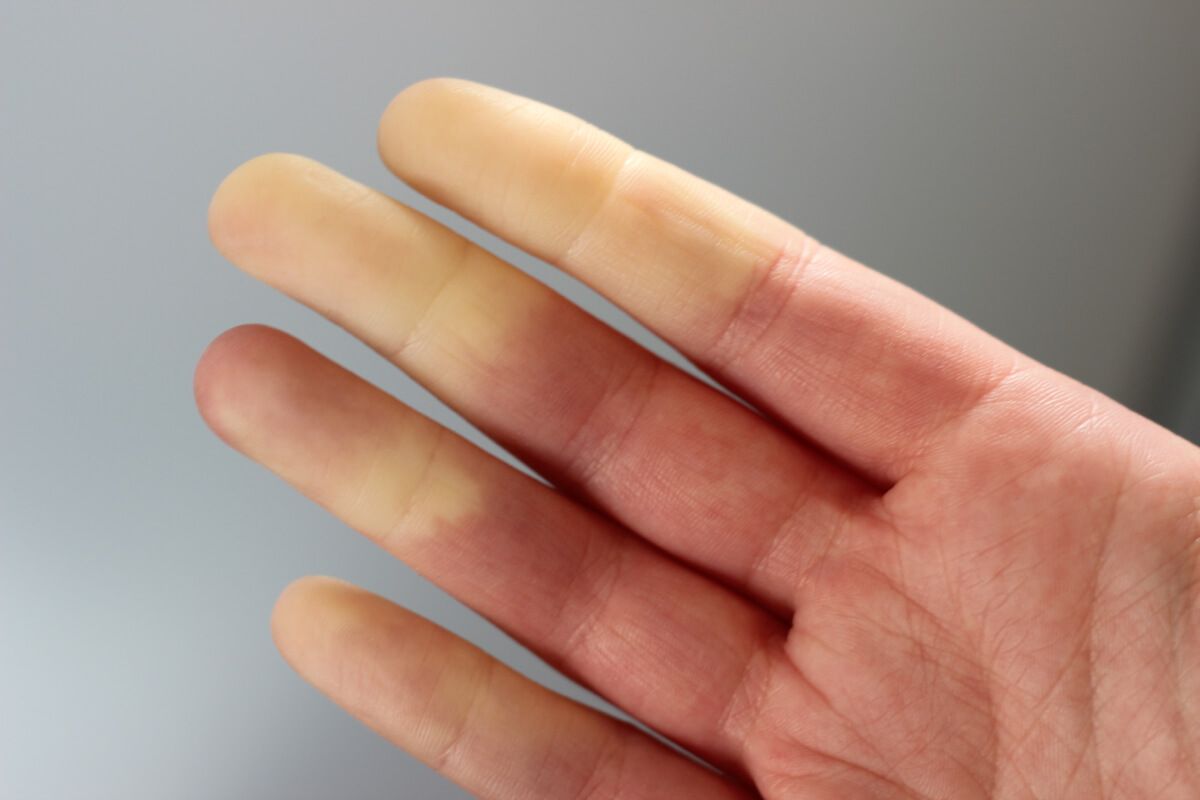 raynaud-szindróma