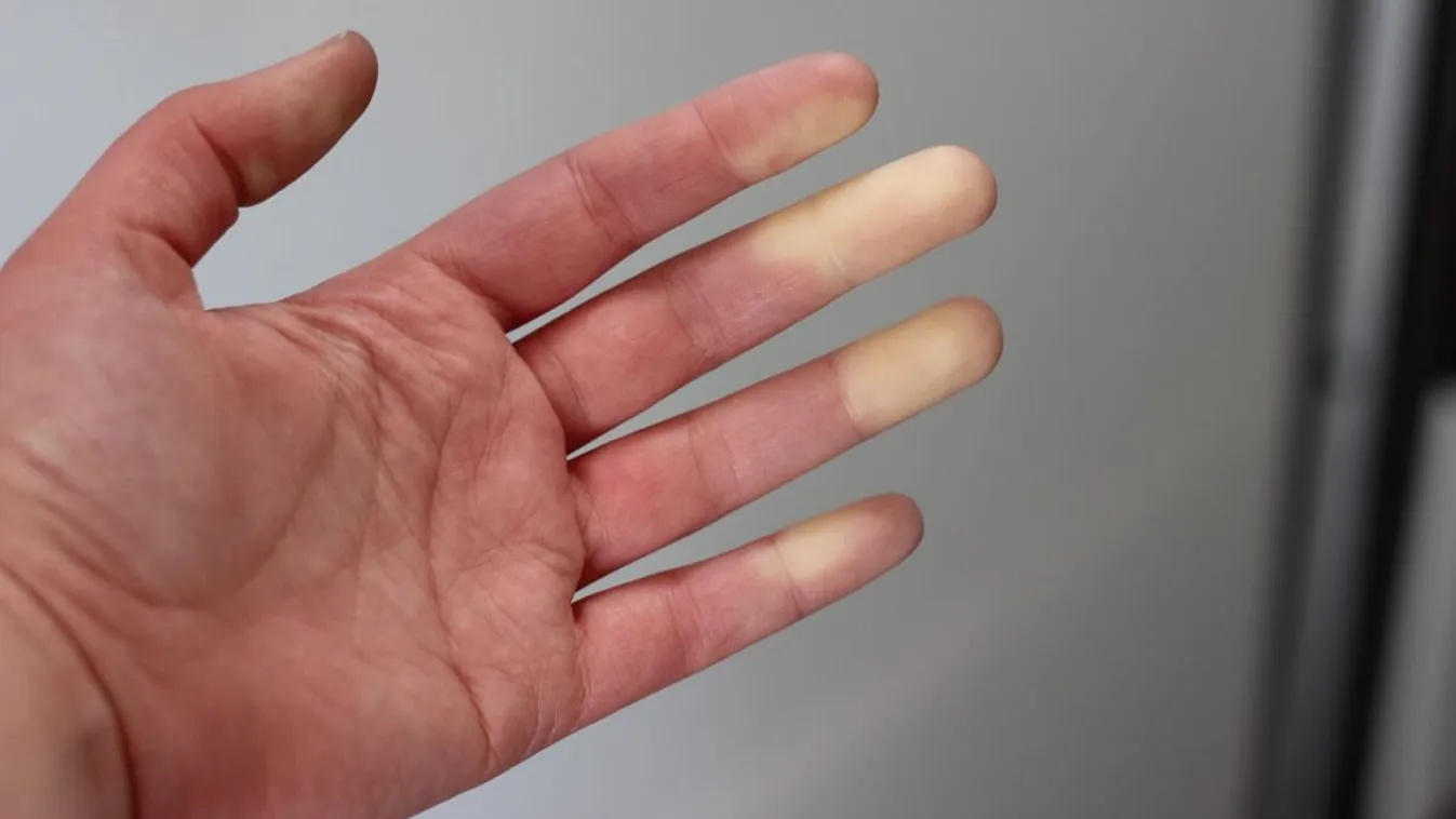 Elfehéredik az ujjad? Neked is Raynaud-szindrómád lehet