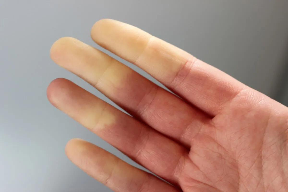 raynaud-szindróma