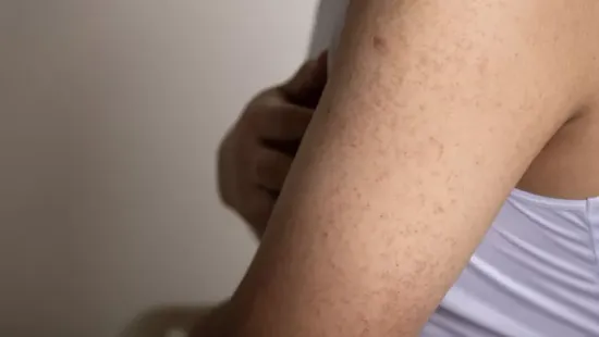 Grízes bőr? Így szabadulhatsz meg a makacs pöttyöktől