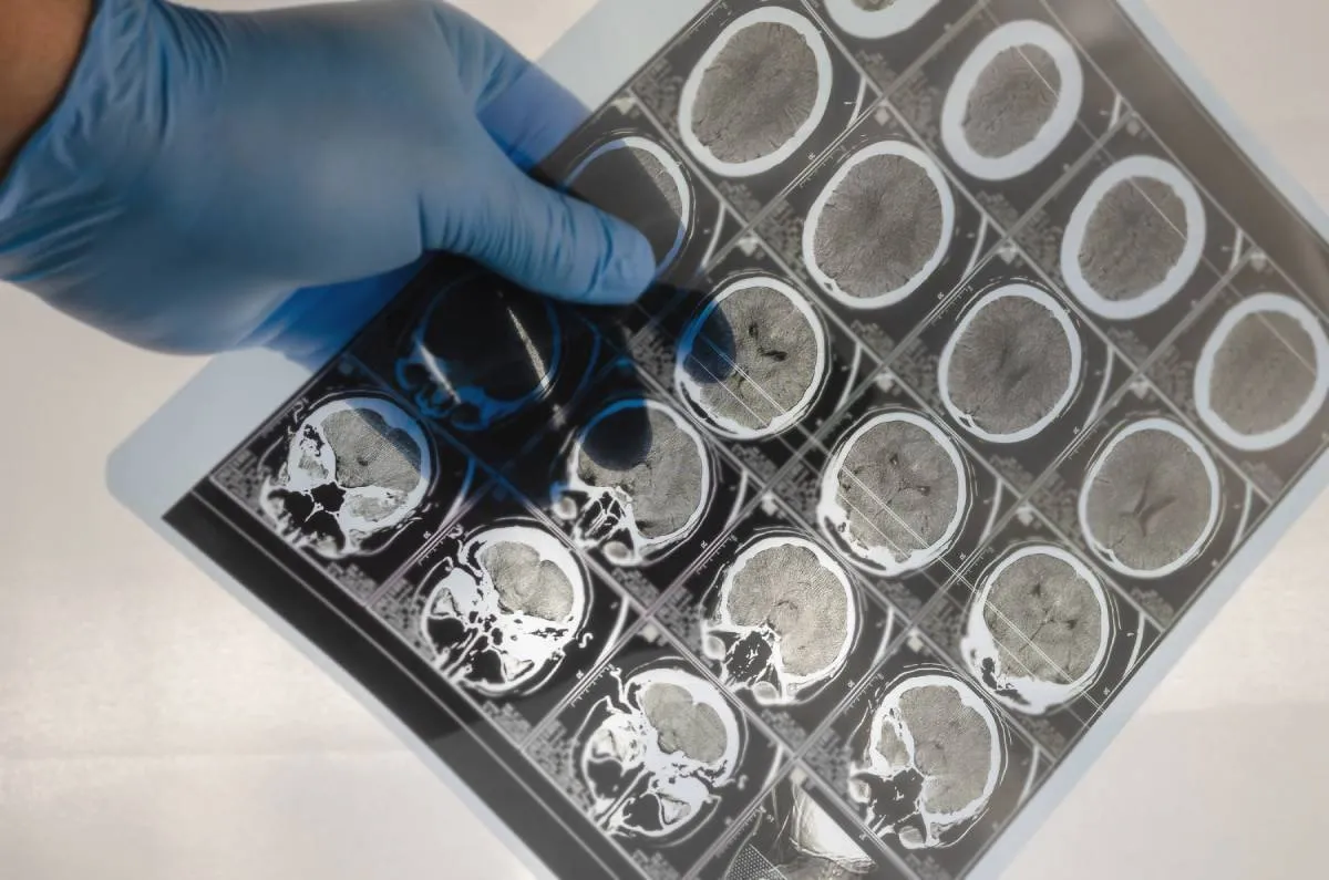 Agyvérzés kockázata: egy bizonyos vércsoport jobban kitett ennek a veszélynek